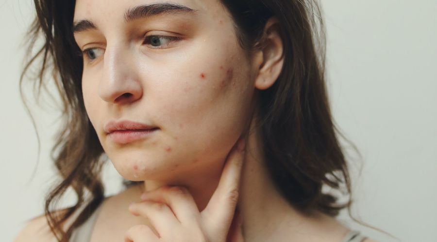 5 kriittisen tärkeää akne hoitotuotetta akneihon hoitoon