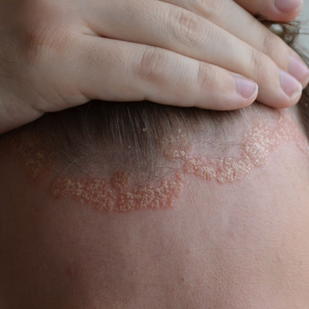 Psoriasis eli psoriaasi