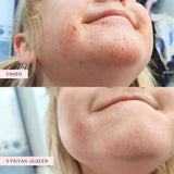 Flow Cosmetics Propolis & Probiotics Rescue Cream hoitovoide ennen ja jälkeen kuvat kasvoilla