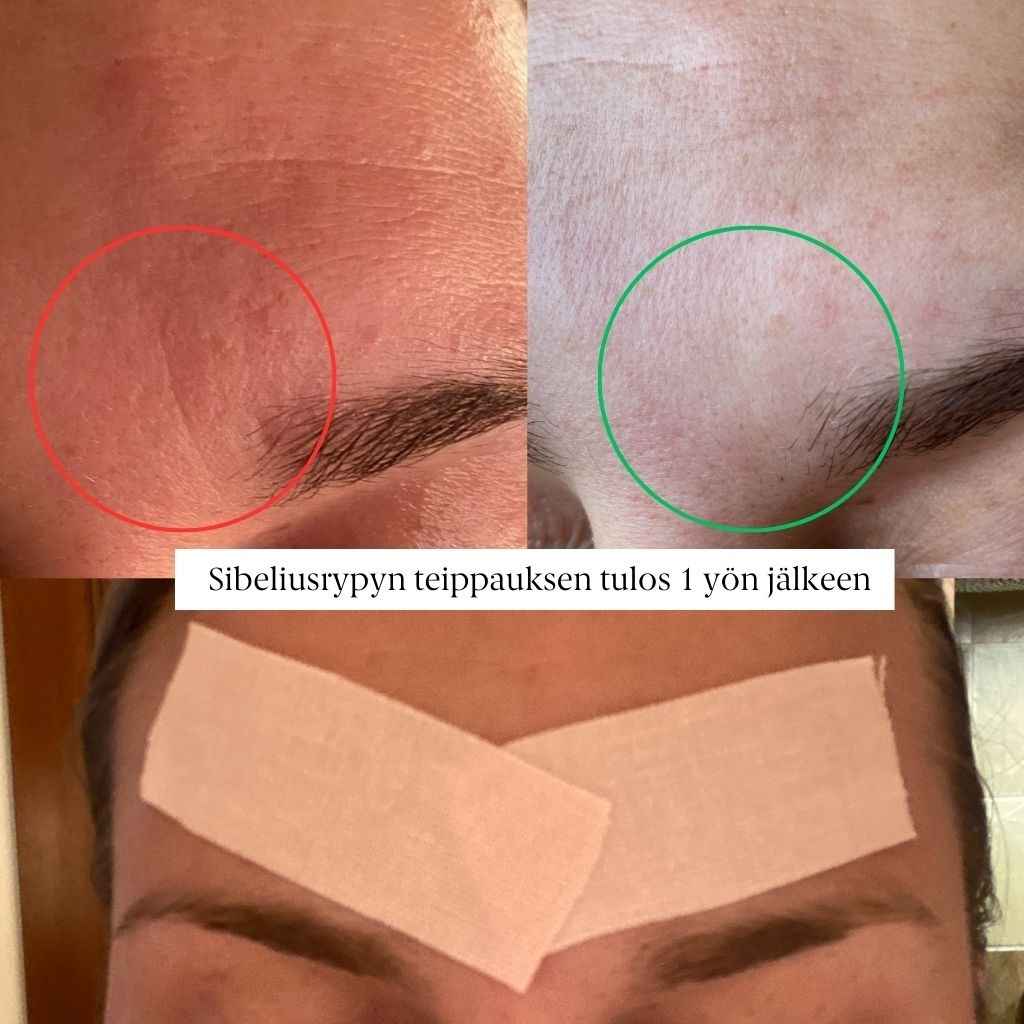 Sibeliusrypyn kinesioteippaus ennen ja jälkeen