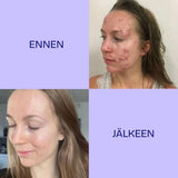 Twistbe jojoba teepuu kasvooljy ennen ja jälkeen käytön
